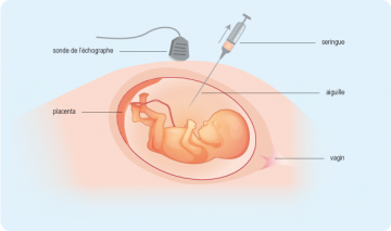 amniocentese ou amniosynthèse