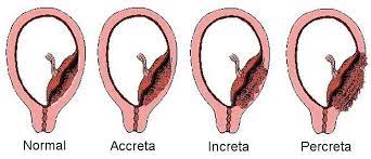 placenta normal, accreta, increta et percreta